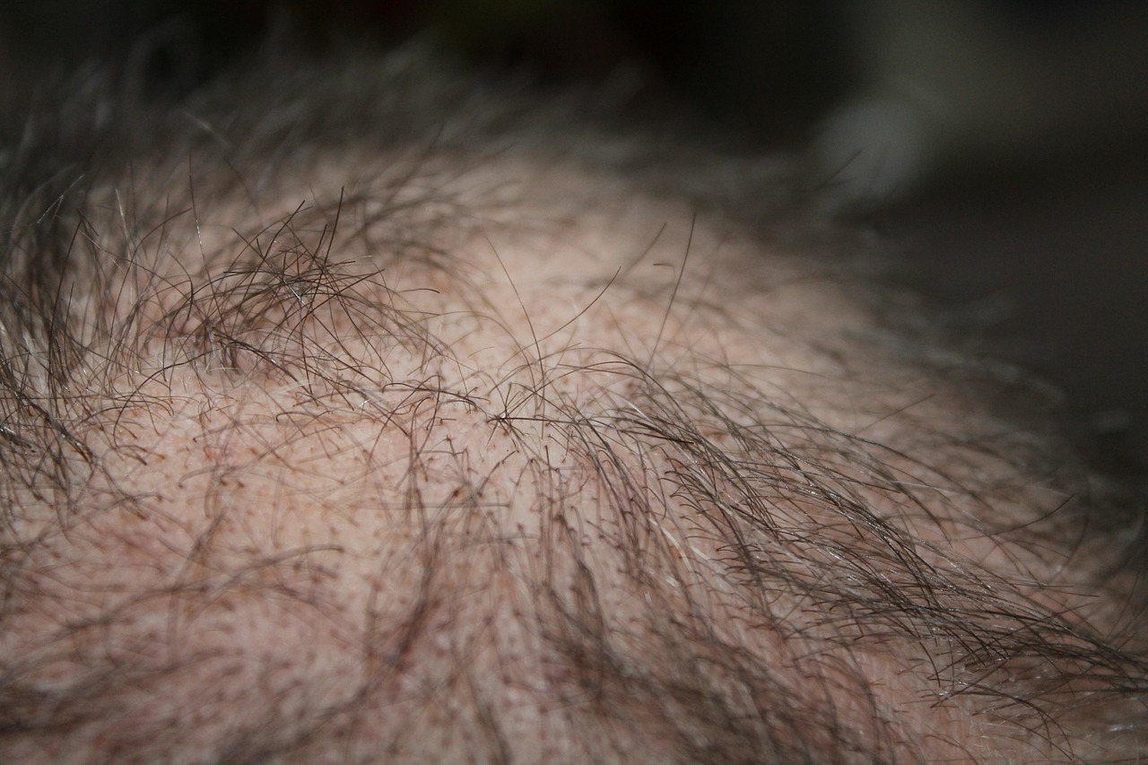 Featured image for “Best Baldness Cap to Aid Your Hair Loss”